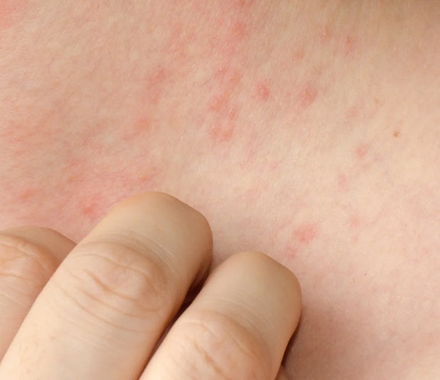 Eczema