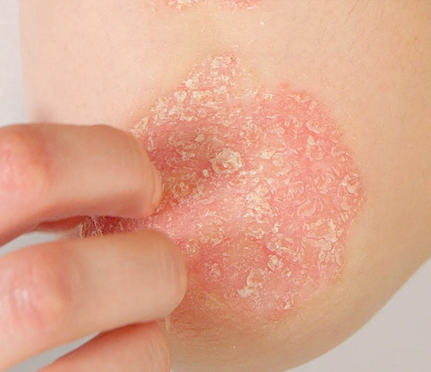 files/conditions-psoriasis.jpg