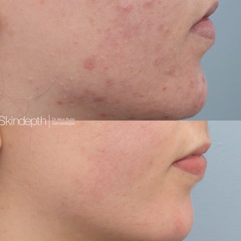 Diet in acne - the glycemic index