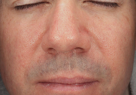 Enlarged Pores: Medical & At-Home Treatment Options