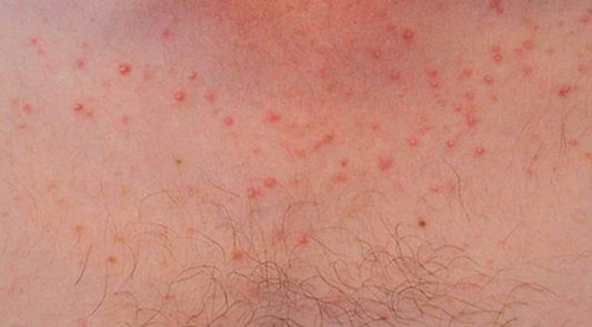 What is Fungal Acne?