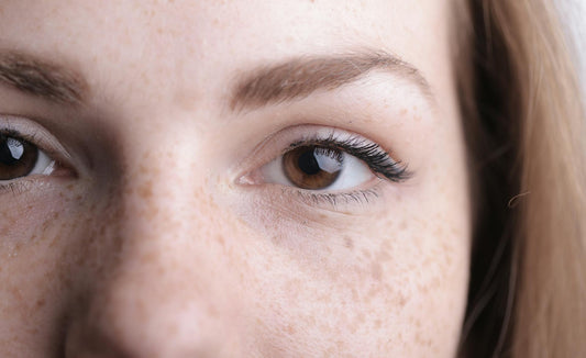 Managing Pigmentation in Summer
