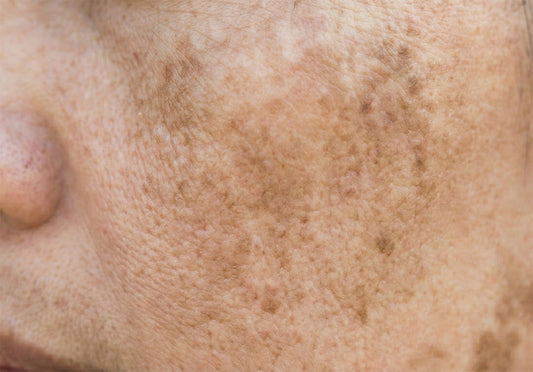 Melasma: Causes, Symptoms & Treatment Solutions at Skindepth Dermatology