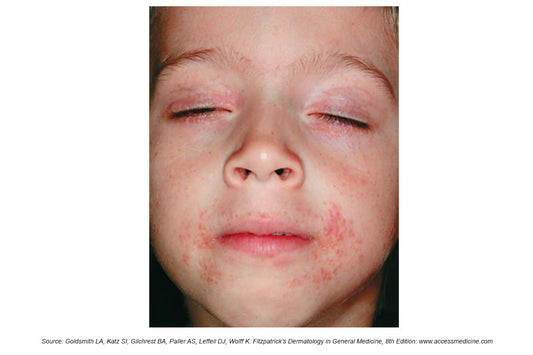 Perioral Dermatitis