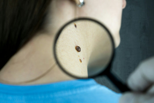 Skin Cancer and Mole Checks in Shepparton – Nurse-Led Outreach Care by Skindepth Dermatology