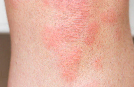 Inflammation and the Skin