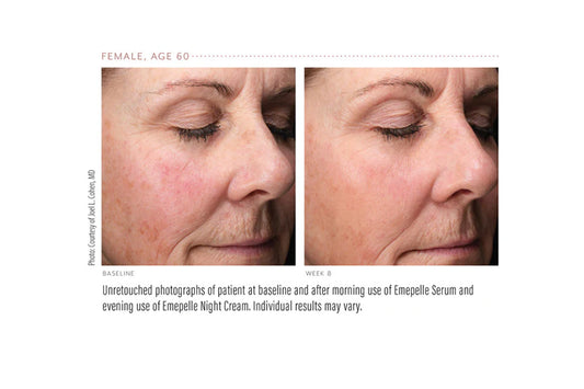 The Implications of Menopause on the Skin