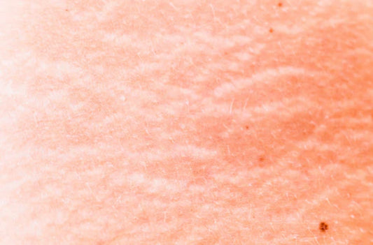 Stretch Marks in Pregnancy