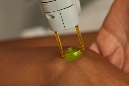 Vbeam Laser in Melbourne: Treating Redness, Veins and Rosacea Before Summer