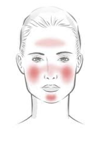 Rosacea - medical or cosmetic