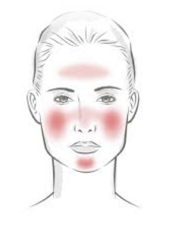 Rosacea - Medical or Cosmetic?