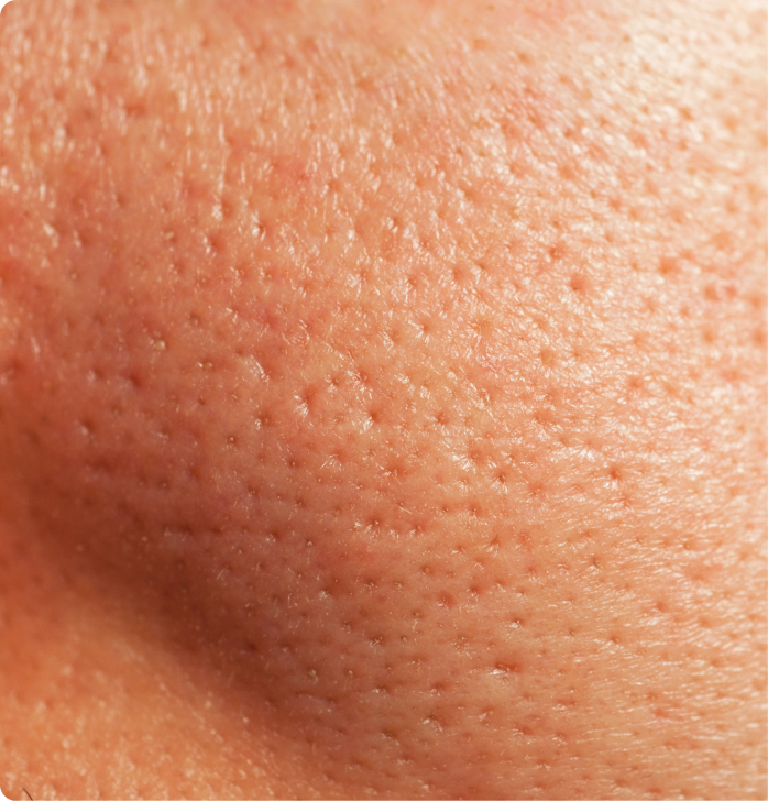 Enlarged Pores