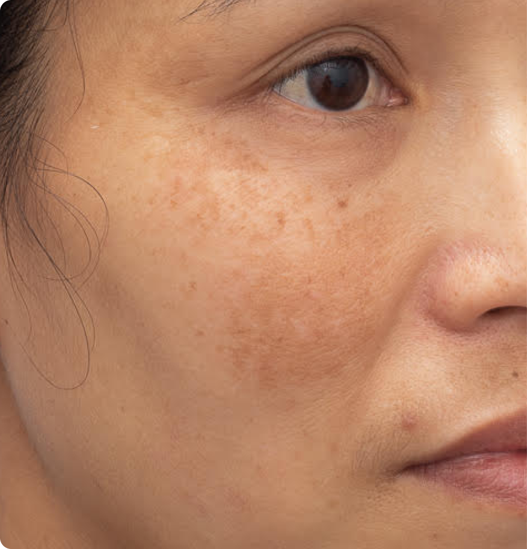 Pigmentation and Discolouration