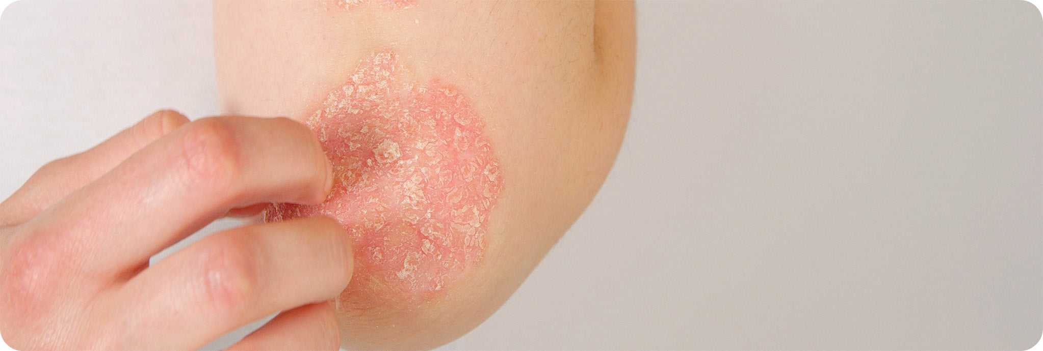 files/Skindepth_Dermatology_Psoriasis.jpg