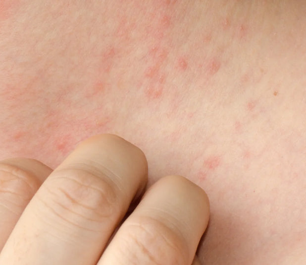 files/conditions-eczema.jpg
